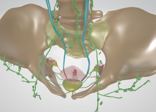 CERVICAL-CANCER-2.png 3D CÁNCER DE CUELLO UTERINO CON ÚTERO, GANGLIOS LINFÁTICOS, SISTEMA URINARIO, VÉRTEBRAS Y PELVIS
