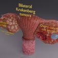 aa-0003.jpg Krukenberg ovarian cancer tumor