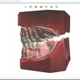 7.jpg Digital Full Dentures for Gluedin Teeth with Manual Reduction