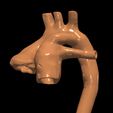 '23.png 3D Model of Transposition of the Great Arteries Open Duct