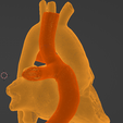 22.png 3D Model of Heart after Fontan Procedure