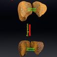 ps17.jpg 3D Alchoholic liver disease cirrhosis hepatitis fatty model
