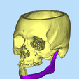 1.png MANDIBLE IMPLANT