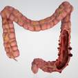 colon,-intestine,-mesenteric,-diverticulitis,-inflammation,-anatomy,-abdominal,-abdomen-2.png 3D Дивертикулит толстой кишки (обновлено)
