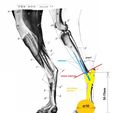 схема-наружнего-протеза2.jpg ITAP implant osseointegration (real operation)