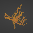 w9.png 3D Model of Middle Cerebral Artery (MCA) Aneurysm