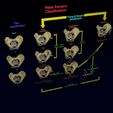 pelvis-fracture-classifications-3d-model-blend-34.jpg Pelvis fracture classifications 3D model