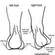 foot-pronation-diagram.jpg Pronation/Supination shoe inserts