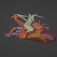 1.png 3D Model of Human Heart with Double Outlet Right Ventricle (DORV) - generated from real patient
