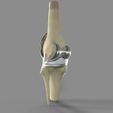 untitled.14.jpg Knee Replacement