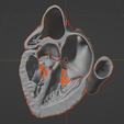 15.png 3D Model of the Heart with Tetralogy of Fallot, parasternal long axis