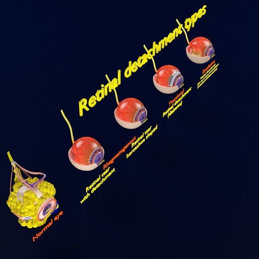 retinal-detachment-types-eye-3d-model-blend-38.jpg Retinal detachment types eye 3D model