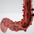 colon,-intestine,-mesenteric,-diverticulitis,-inflammation,-anatomy,-abdominal,-abdomen-4.png 3D Дивертикулит толстой кишки (обновлено)