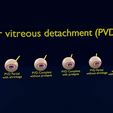 posterior-vitreous-detachment-types-eye-3d-model-blend-37.jpg Posterior vitreous detachment types eye 3D model