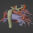 9.png 3D Model of Human Heart with Ventricular Septal Defect (VSD)