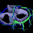 12.png 3D Model of Common Arterial Trunk Truncus Arteriosus