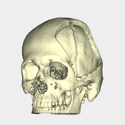 Skull-1.jpg Download STL file Skull-cranial defect • 3D printing object, Additiveindia