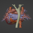 2.png 3D Model of Human Heart with Atrial Septal Defect (ASD) - generated from real patient
