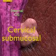 0026.jpg Fibroid Uterus Human female 3D