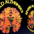 ps39.jpg Alzheimer Disease Brain coronal slice