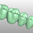 Clipboard-2024-02-25-15-05-45.jpg FLEXIBLE PARTIAL DENTURE (upper base + artificial teeth)