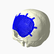 Capture3.png CRANIAL IMPLANT WITH DEFECT