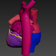 03.png 有心房间隔缺损的心脏 3D 模型