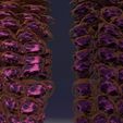 ps110.jpg Cervical cancer dysplasia CIN 3D model