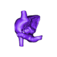 papvcheart1.stl 3D Model of Partial Anomalous Pulmonary Venous Connection