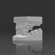 Captura-de-tela-2025-06-05-200042.png Model with Tooth Loss and Accentuated Curve of Spee