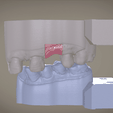 Screenshot_15.png Digital Implant Model with Soft Tissue