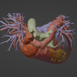 5.png Modèle 3D de cœur humain avec transposition des grandes artères (TGA) - généré à partir d'un patient réel