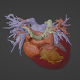 5.png 3D Model of Human Heart with Aortic Arch Hypoplasia (AAH) - generated from real patient