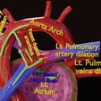 ps-0031.jpg PDA Patent Ductus Arteriosus vs Normal blood circulation