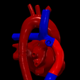 3.png 3D Model of Heart after Fontan Procedure