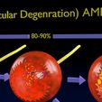 md3899.jpg Age-related macular degeneration AMD ARMD detailed labelled