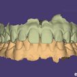 Viewer-PAC-A-Render-Yeso.jpg BOTH MAXILLARS - SUPERIOR and INFERIOR "ready for 3D printer" - AREA3D- Patient A. COMPLETE DENTURE