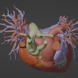 5.png 3D Model of Human Heart with Atrial Septal Defect (ASD) - generated from real patient