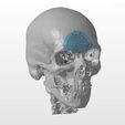 cranio-2.jpg A cranial plate to replace a skull defect (an example of a real operation 2)