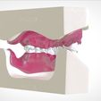 14.jpg Digital Full Dentures for Gluedin Teeth with Manual Reduction