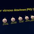 posterior-vitreous-detachment-types-eye-3d-model-blend-72.jpg Posterior vitreous detachment types eye 3D model
