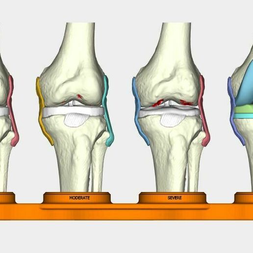 total knee replacement model ( TKR ), EDUCATING / TEACHING MODEL