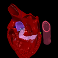 1.png 3D Model of Heart wirh Atrioventricular Septal Defect, 4 chamber view