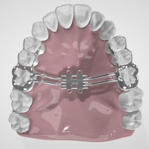 High resolution 3 Parts Miniscrew Assisted Rapid Palatal Expansion (MARPE) Dental Appliance