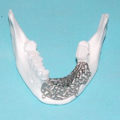 33-implant.jpg STL file Individual mesh membrane for bone reconstruction of the jaw (examples of real operations)・Model to download and 3D print