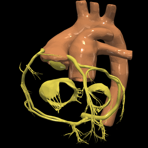 15.png 3D Model of Transposition of the Great Arteries Open Duct