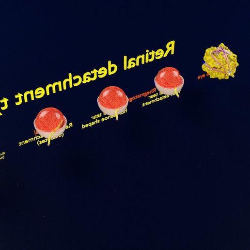 retinal-detachment-types-eye-3d-model-blend-39.jpg Retinal detachment types eye 3D model