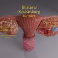 image-0036.jpg Krukenberg ovarian cancer tumor
