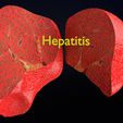 ps10.jpg 3D Alchoholic liver disease cirrhosis hepatitis fatty model
