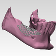 8013101_grid-2.png Individual mesh membrane for bone reconstruction of the jaw (examples of real operations)